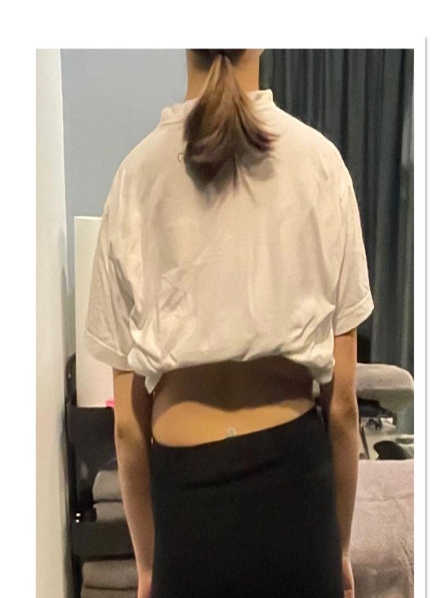 After - Shoulder Pain and Mobility Recovery