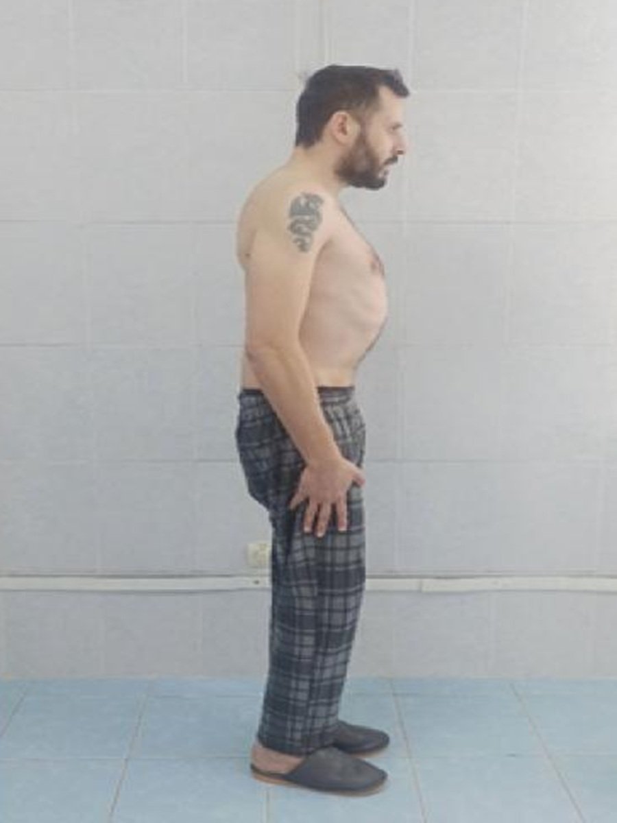 After - Lower Back Pain Management